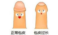 龟头炎
